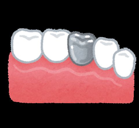 口の中に銀歯あるやついる?